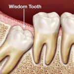 How Are Wisdom Teeth Removed – Elite Dental Care Tracy