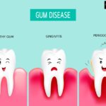 How to Know If You Have Gum Disease and What to Do About It – Elite Dental Care Tracy