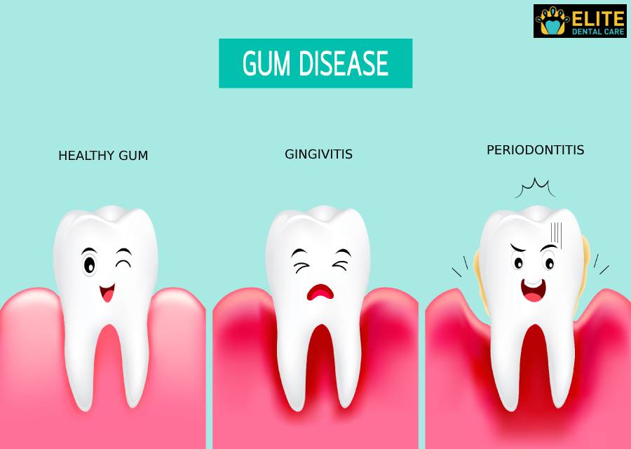 How to Know If You Have Gum Disease and What to Do About It – Elite Dental Care Tracy