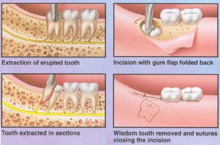 Removal of Wisdom teeth