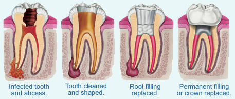 Root Canal Filling process