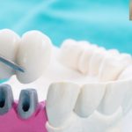 How to Take Care of Your Dental Bridges – Elite Dental Care Tracy
