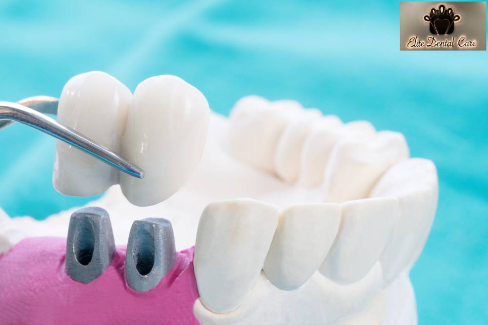 How to take care of your dental bridges – elite dental care tracy