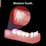 What Happens During Wisdom Teeth Extraction – Elite Dental Care Tracy