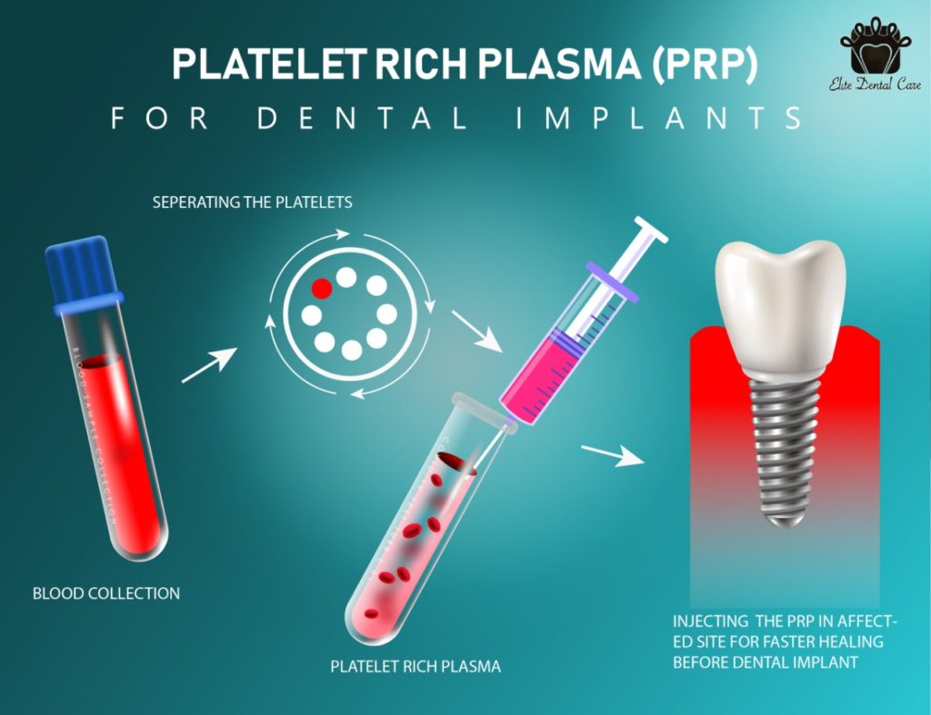 Effect of PRP on the Stability of Dental Implants Elite Dental Care Tracy