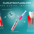 Effect of PRP on the Stability of Dental Implants – Elite Dental Care Tracy