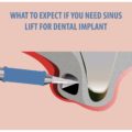 What to Expect if You Need a Sinus Lift for Dental – Elite Dental Care Tracy