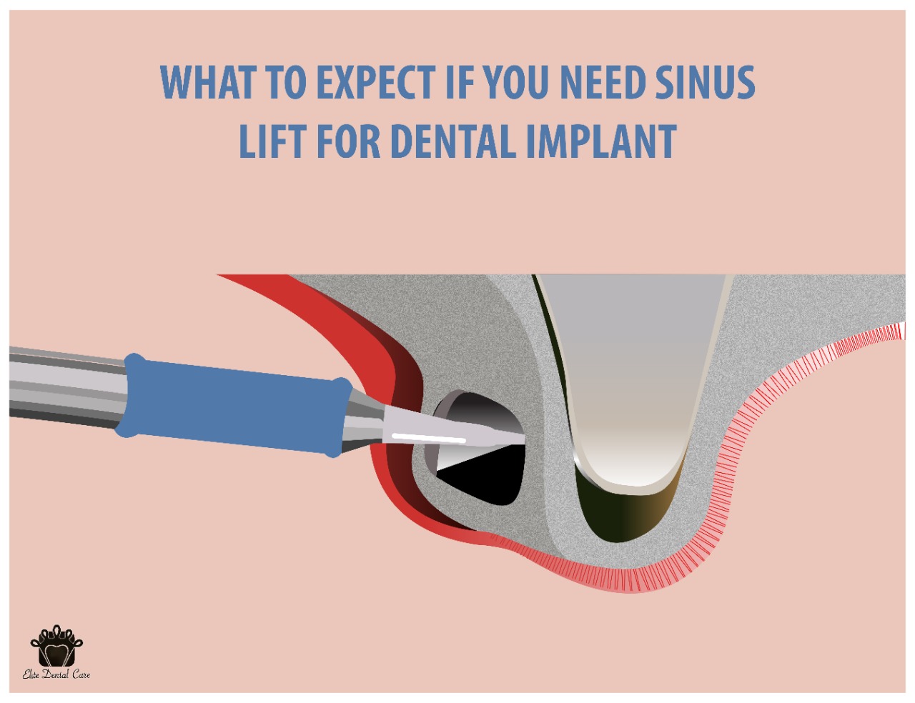 What to Expect if You Need a Sinus Lift for Dental – Elite Dental Care Tracy