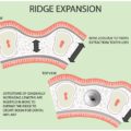 Ridge Expansion and Technique – Elite Dental Care Tracy