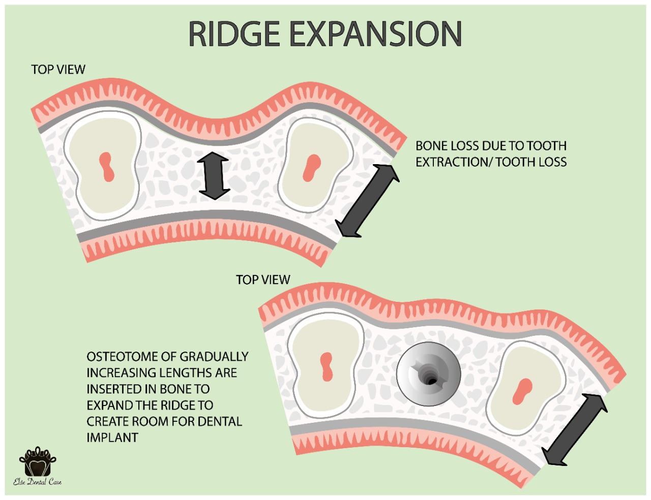 Ridge Expansion and Technique