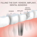 Filling the Gaps: Veneers, Implants, Dental Bonding – Elite Dental Care Tracy