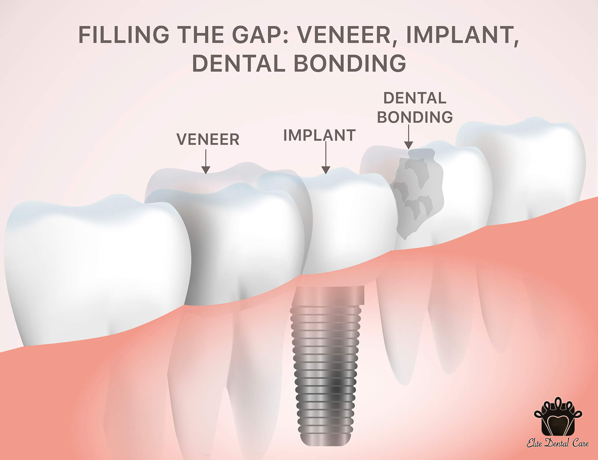Filling the Gaps: Veneers, Implants, Dental Bonding