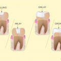 Fillings VS Inlay/Onlay VS Crown – Elite Dental Care Tracy