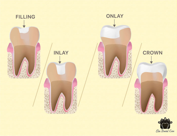 Fillings VS Inlay/Onlay VS Crown Elite Dental Care Tracy