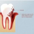 Why is it Important to Treat Periodontitis Disease – Elite Dental Care Tracy