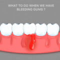 What Do You Do When Your Gums Are Bleeding – Elite Dental Care Tracy