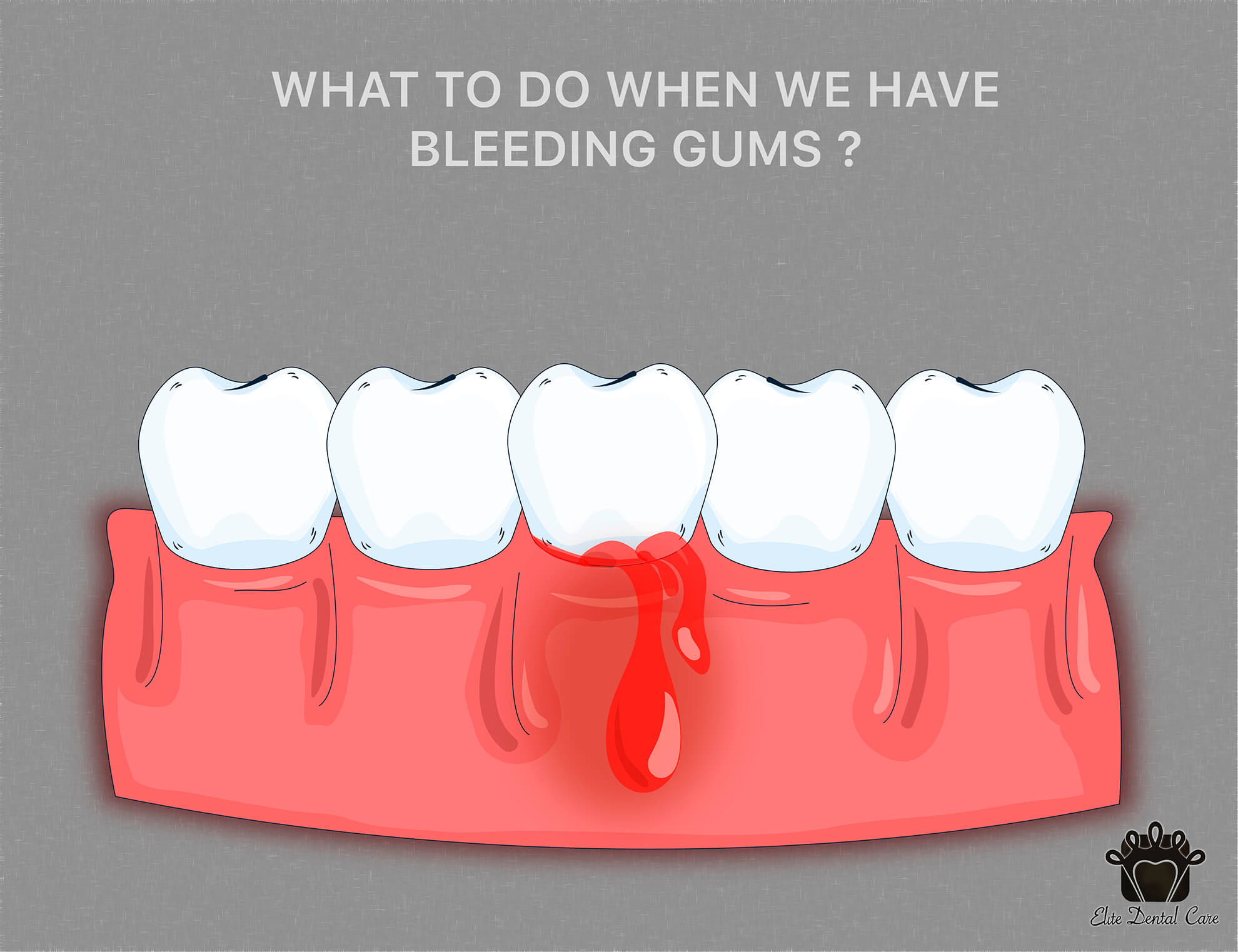 What Do You Do When Your Gums Are Bleeding