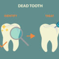 Identifying and Treating a Dead Tooth – Elite Dental Care Tracy