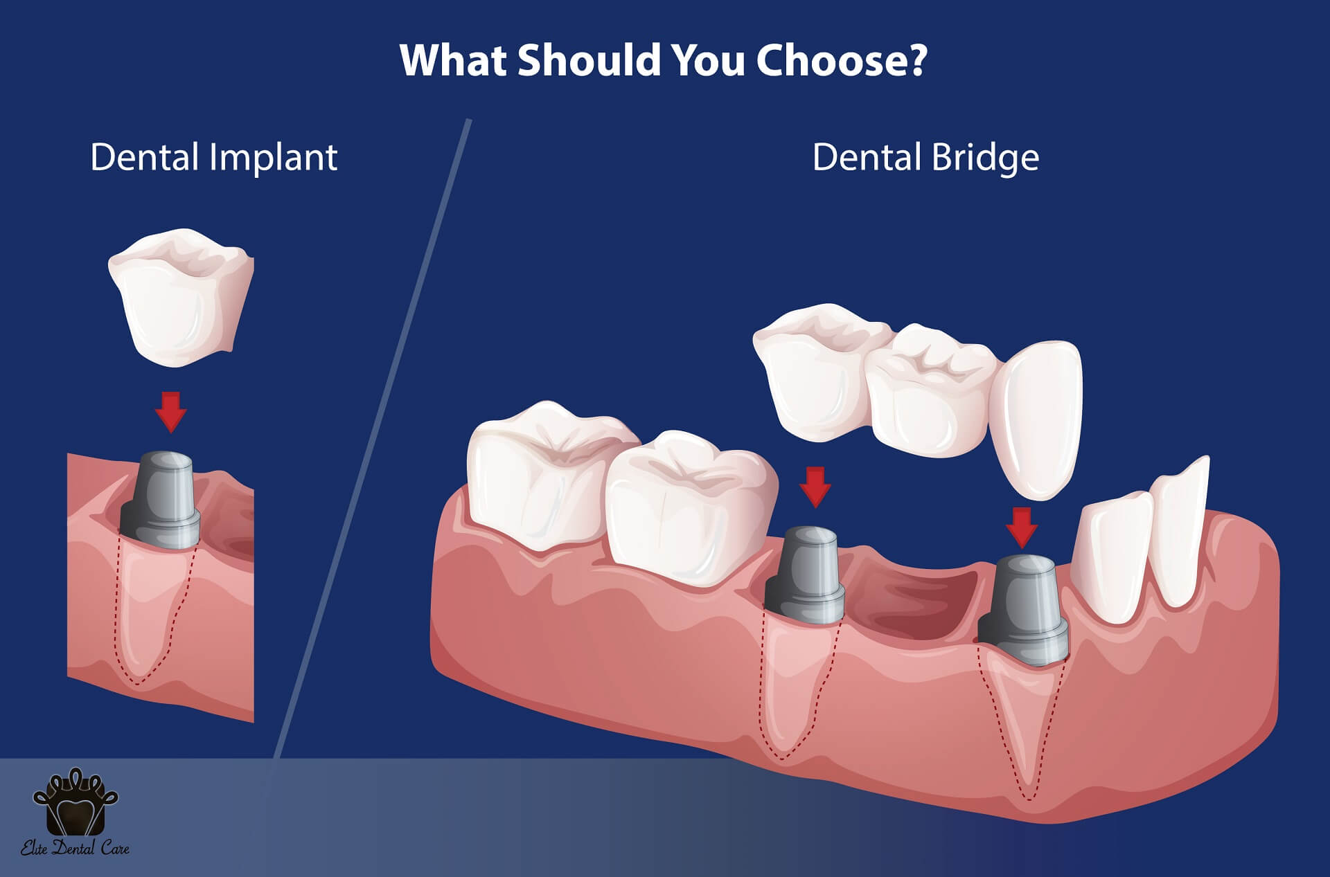 Dental Implants v/s Dental Bridges
