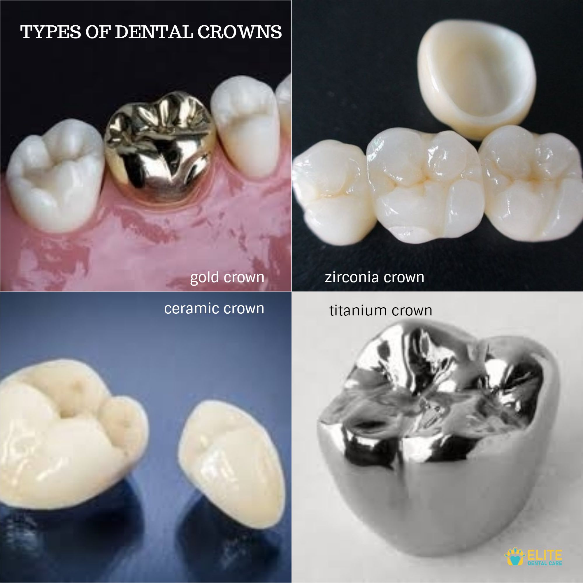 TYPES OF DENTAL CROWNS FOR DIFFERENT PATIENTS – ELITE DENTAL CARE TRACY