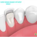 HOW DO DENTAL VENEERS PROTECT FROM THE DENTAL DAMAGE – THE ELITE DENTAL CARE