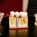 SAVE YOUR TEETH WITH ROOT CANAL TREATMENT – ELITE DENTAL CARE TRACY