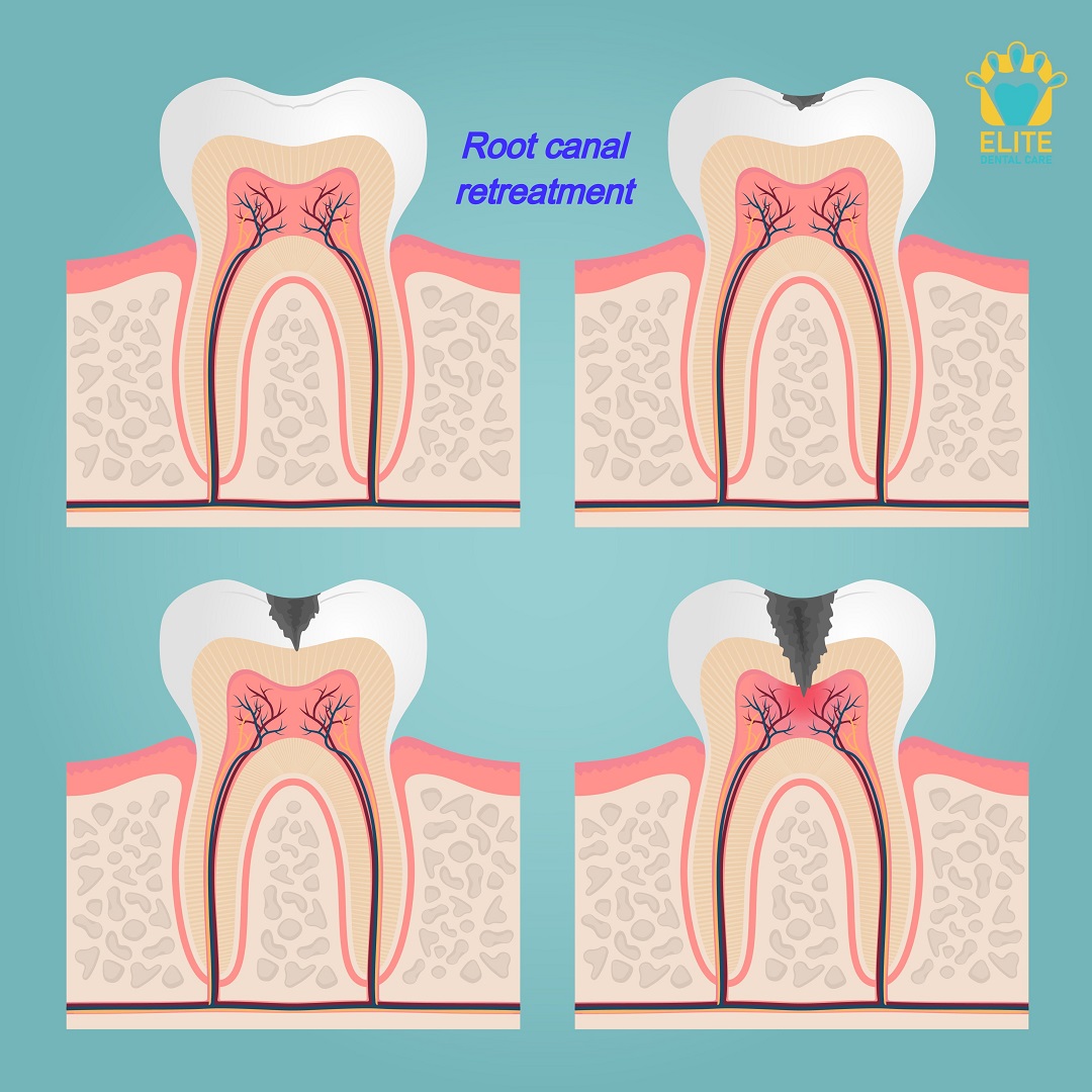 ROOT CANAL RETREATMENT – ELITE DENTAL CARE TRACY