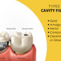 TYPES OF CAVITY FILLINGS – ELITE DENTAL CARE TRACY