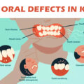ORAL DEFECTS IN CHILDREN – ELITE DENTAL CARE TRACY