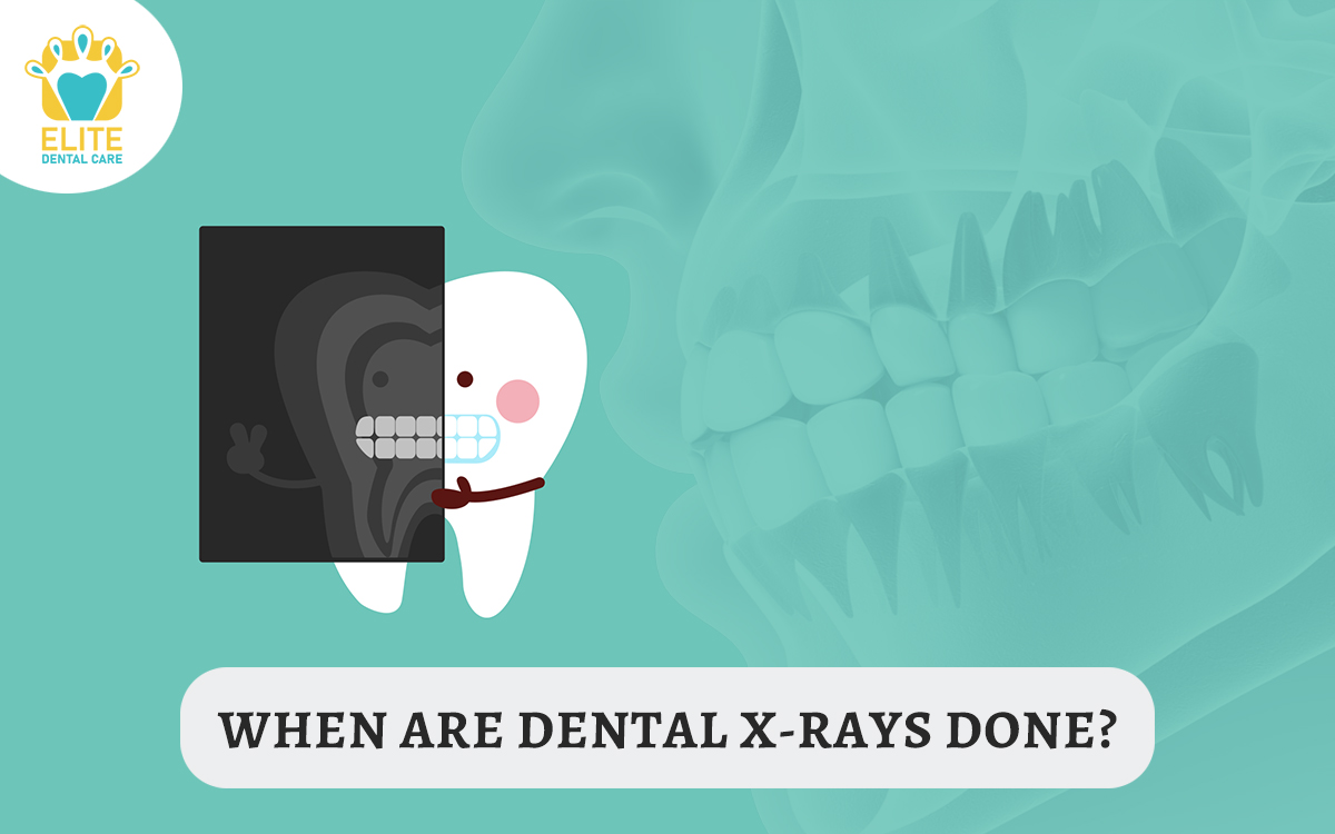 WHEN ARE DENTAL X-RAYS DONE? – ELITE DENTAL CARE TRACY