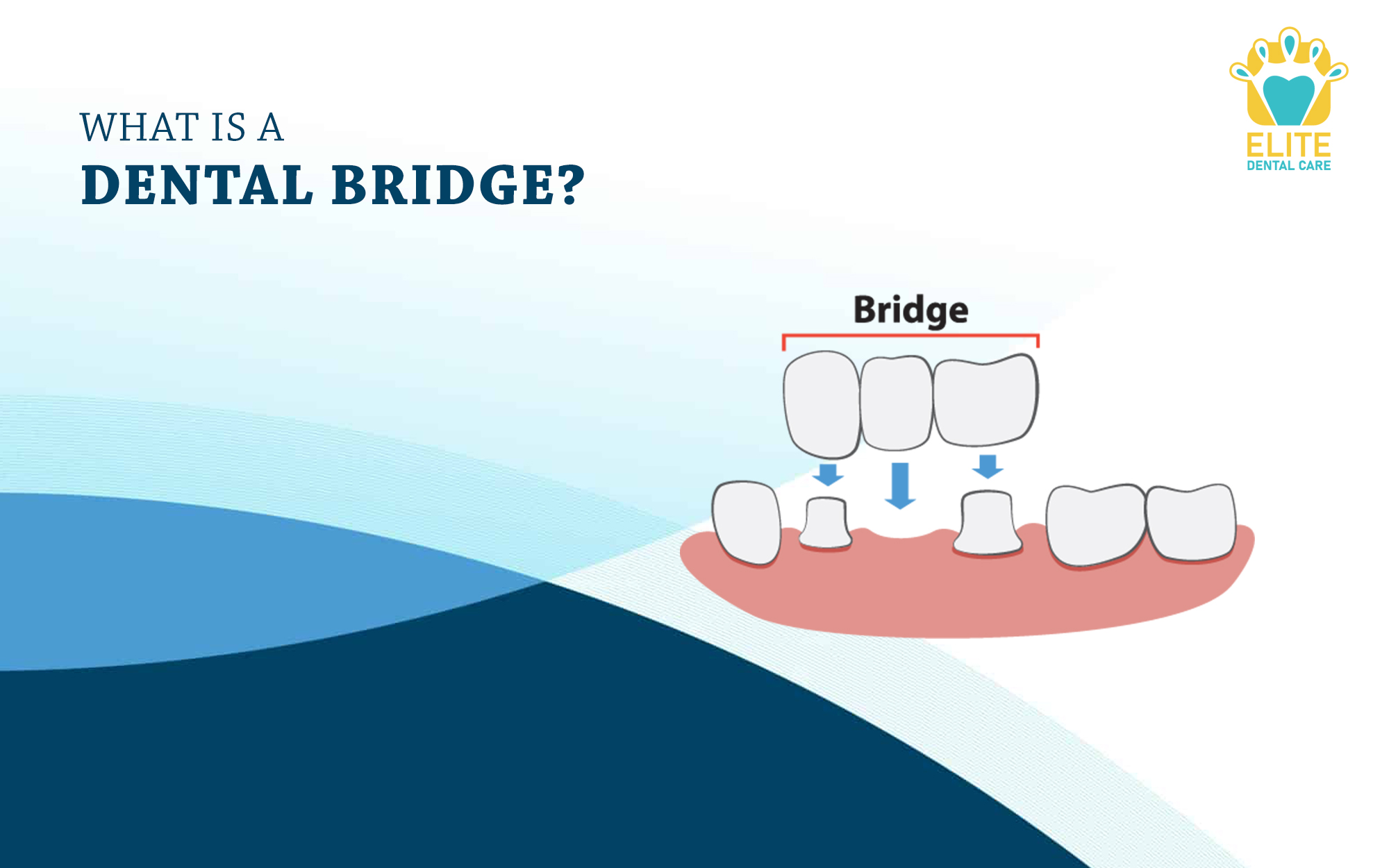 WHAT IS A DENTAL BRIDGE – ELITE DENTAL CARE, TRACY