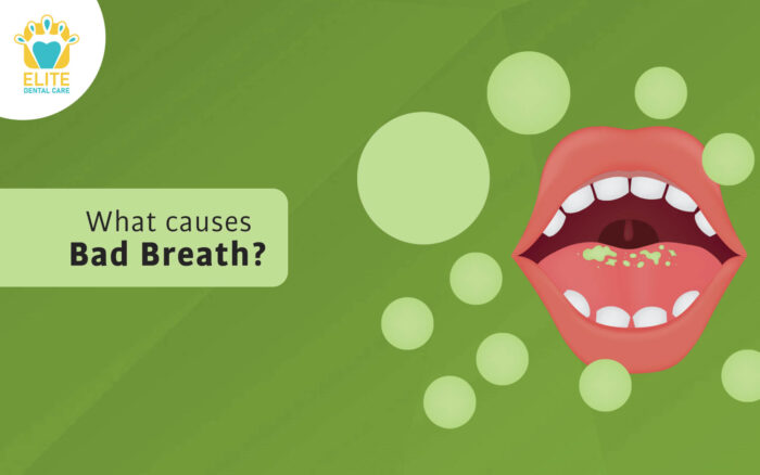 WHAT CAUSES BAD BREATH Elite Dental Care