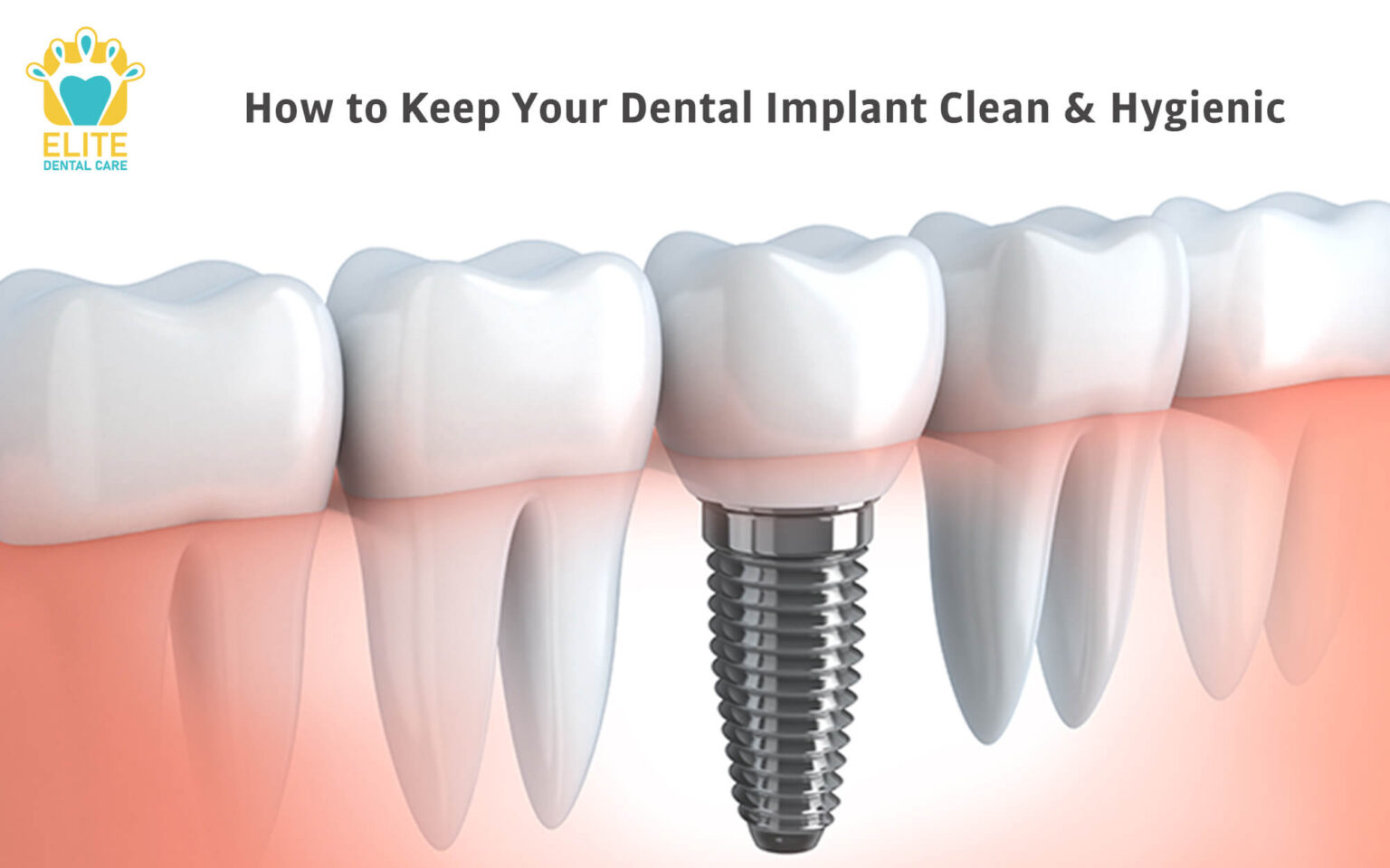 HOW TO KEEP YOUR DENTAL IMPLANTS CLEAN & HYGIENIC Elite Dental Care