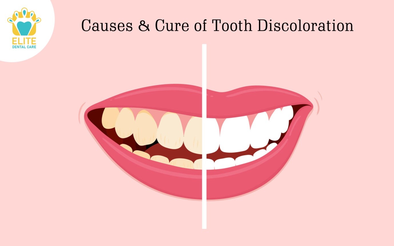 CAUSES & CURE OF TOOTH DISCOLORATION