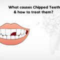 CHIPPED TEETH: CAUSES & TREATMENT