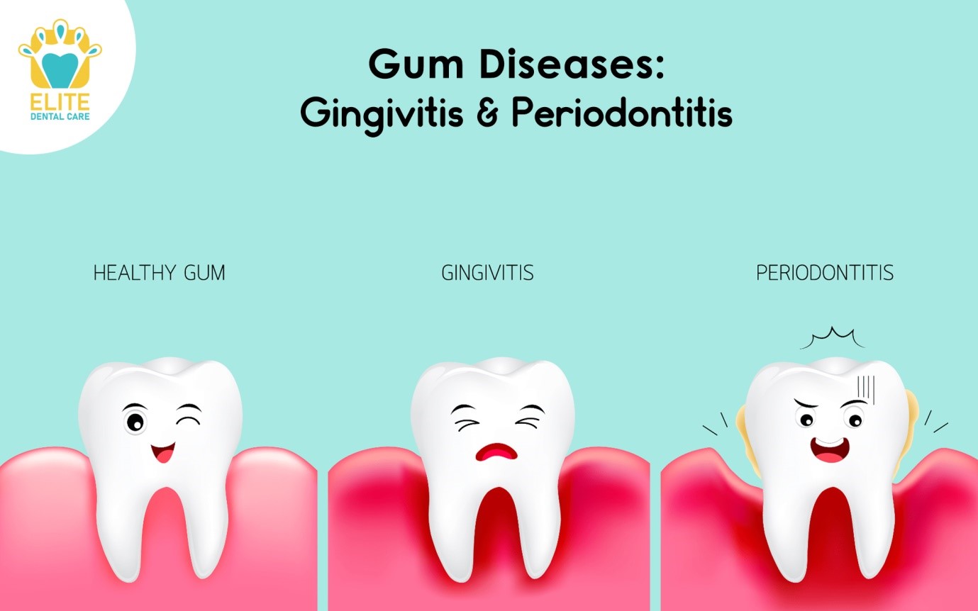 GUM DISEASES: GINGIVITIS & PERIODONTITIS