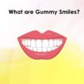 WHAT ARE GUMMY SMILES