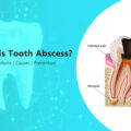 TOOTH ABSCESS: SYMPTOMS, CAUSES & PREVENTION