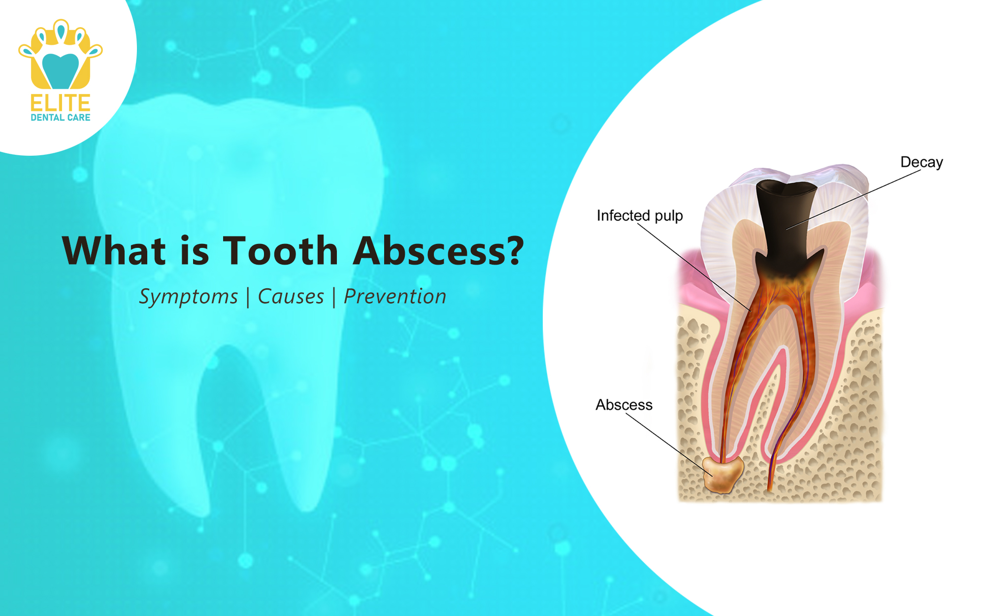 TOOTH ABSCESS: SYMPTOMS, CAUSES & PREVENTION