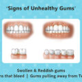 SIGNS OF UNHEALTHY GUMS