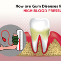 HOW ARE GUM DISEASES LINKED TO HIGH BLOOD PRESSURE