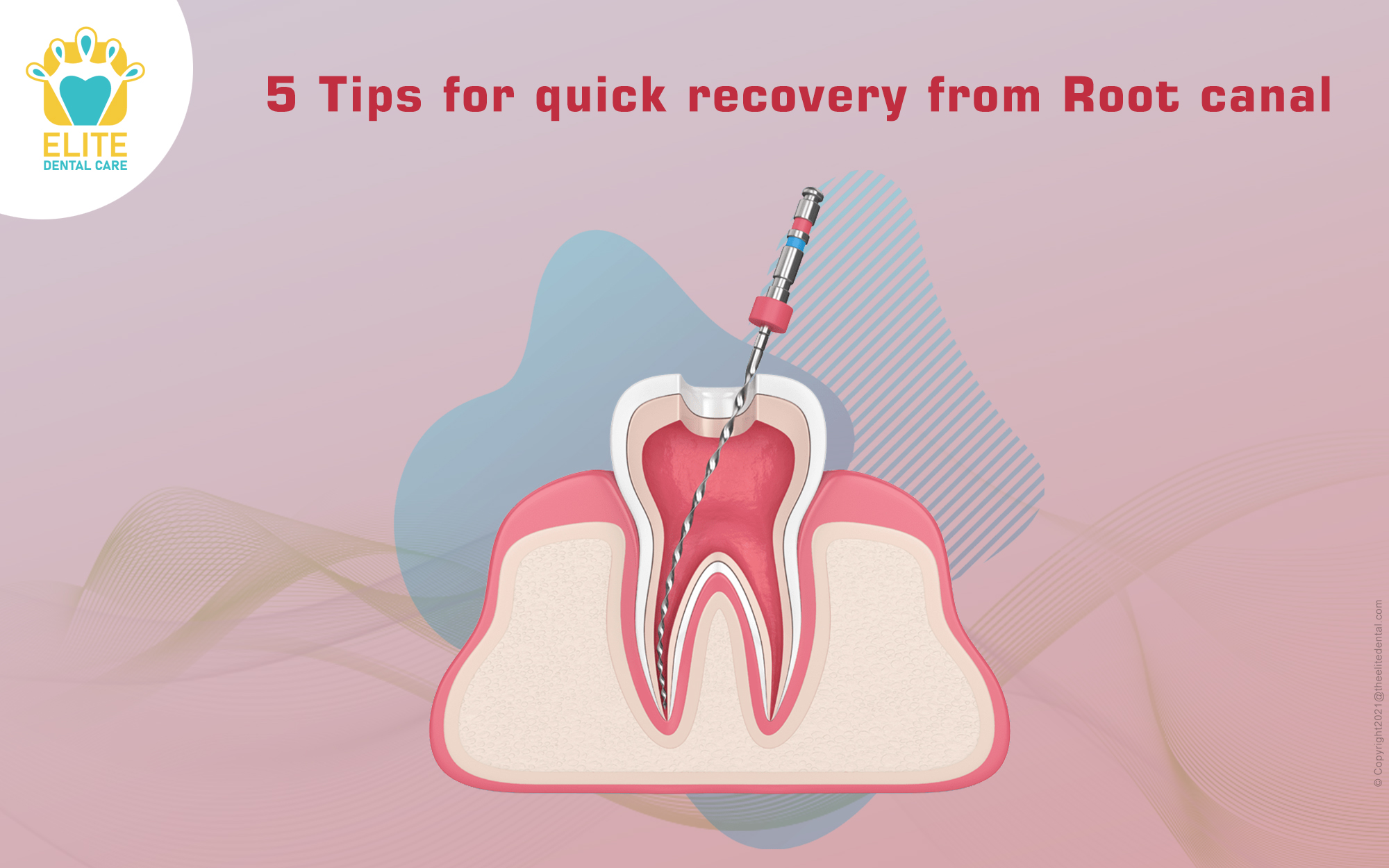 5 TIPS TO SPEED UP ROOT CANAL RECOVERY