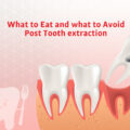 FOODS TO EAT & AVOID AFTER TOOTH EXTRACTION