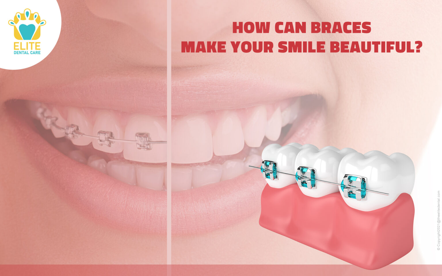 HOW CAN BRACES MAKE YOUR SMILE BEAUTIFUL? - Elite Dental Care