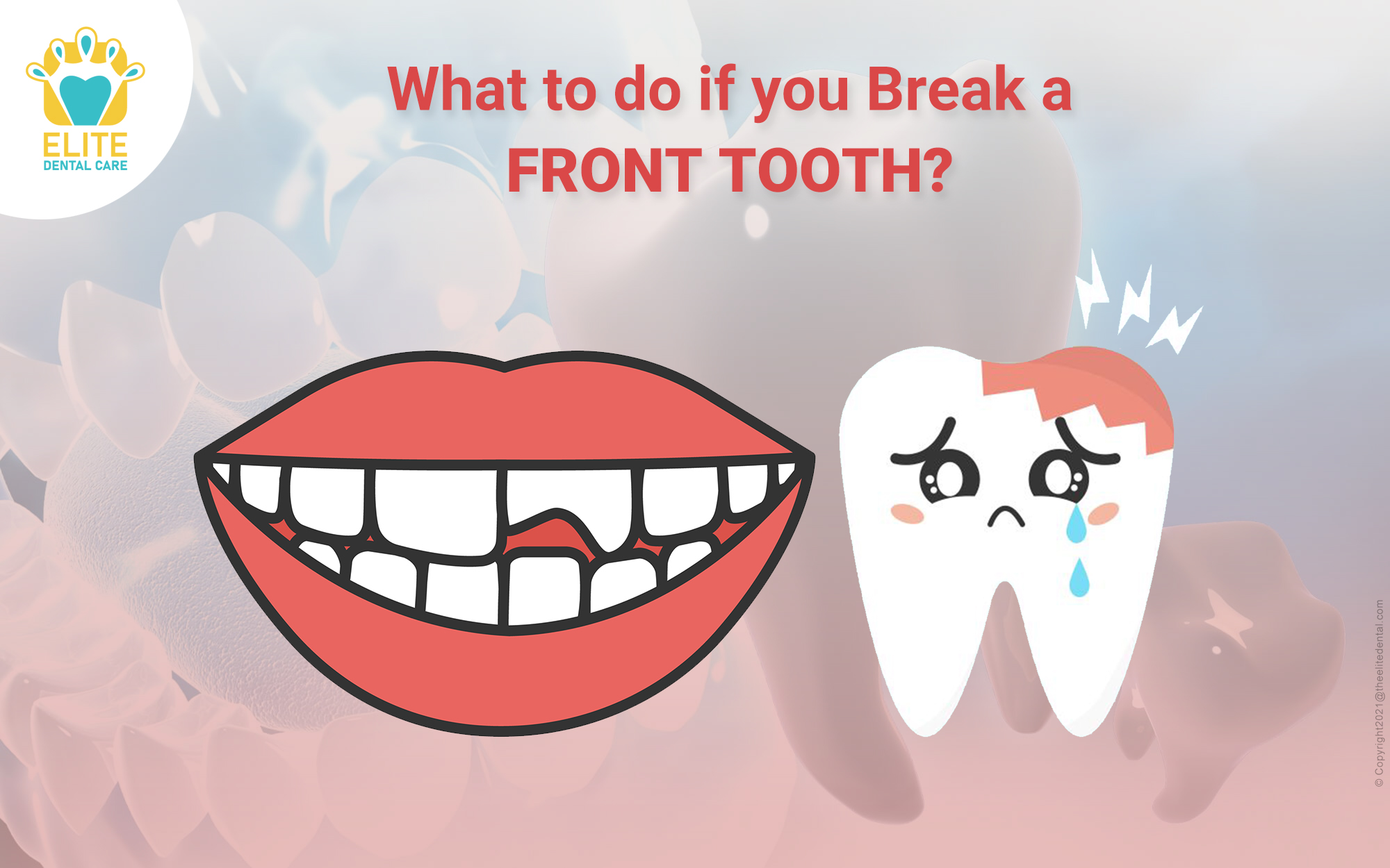 Steps to Follow If You Break Your Front Tooth