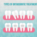 10 Types of Orthodontic treatment