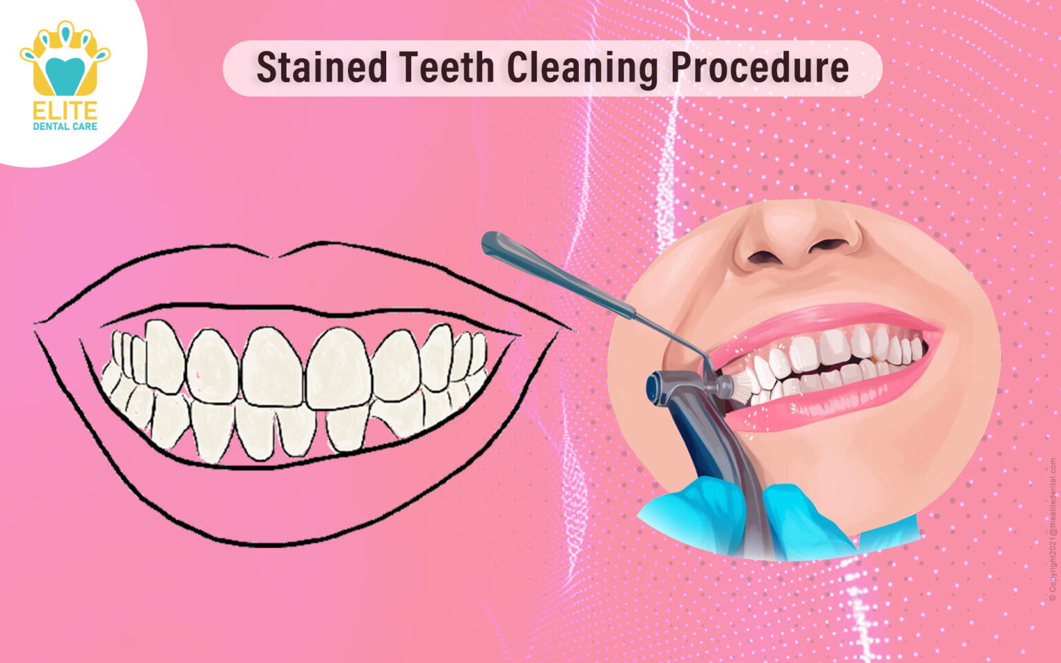 Stained Teeth Cleaning Procedure Elite Dental Care