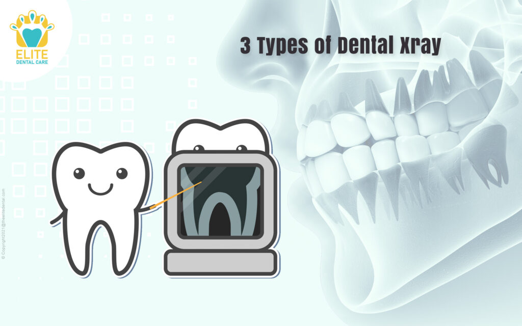 3 Types of Dental Xray Elite Dental Care