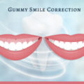 Gummy Smile Correction