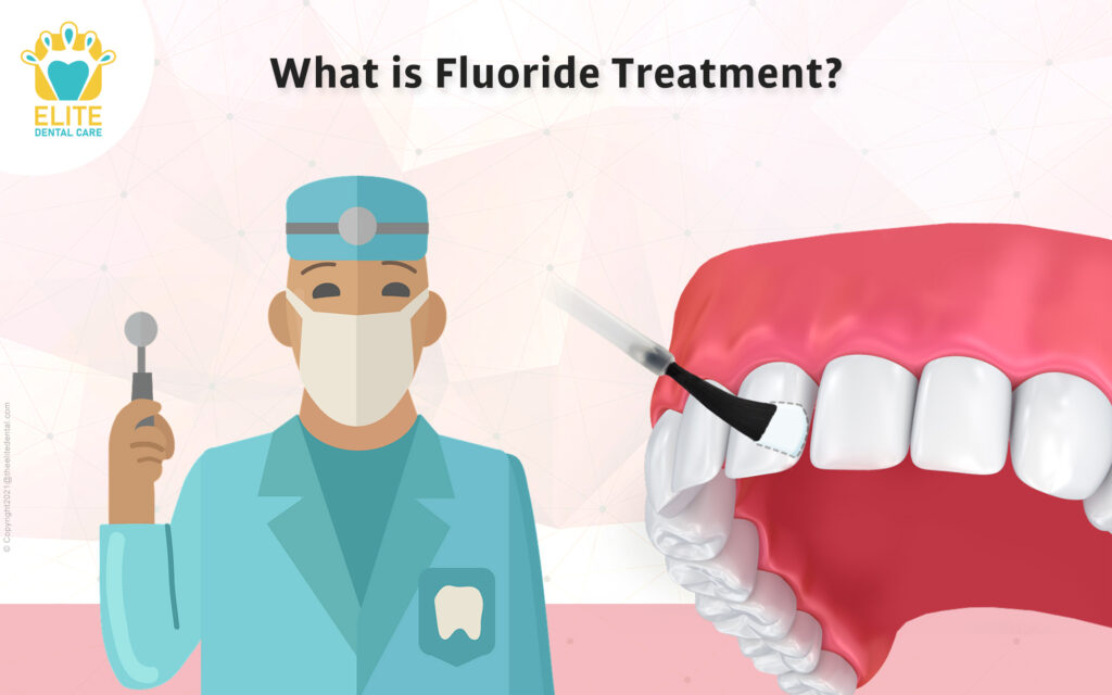 What is Fluoride treatment? Elite Dental Care